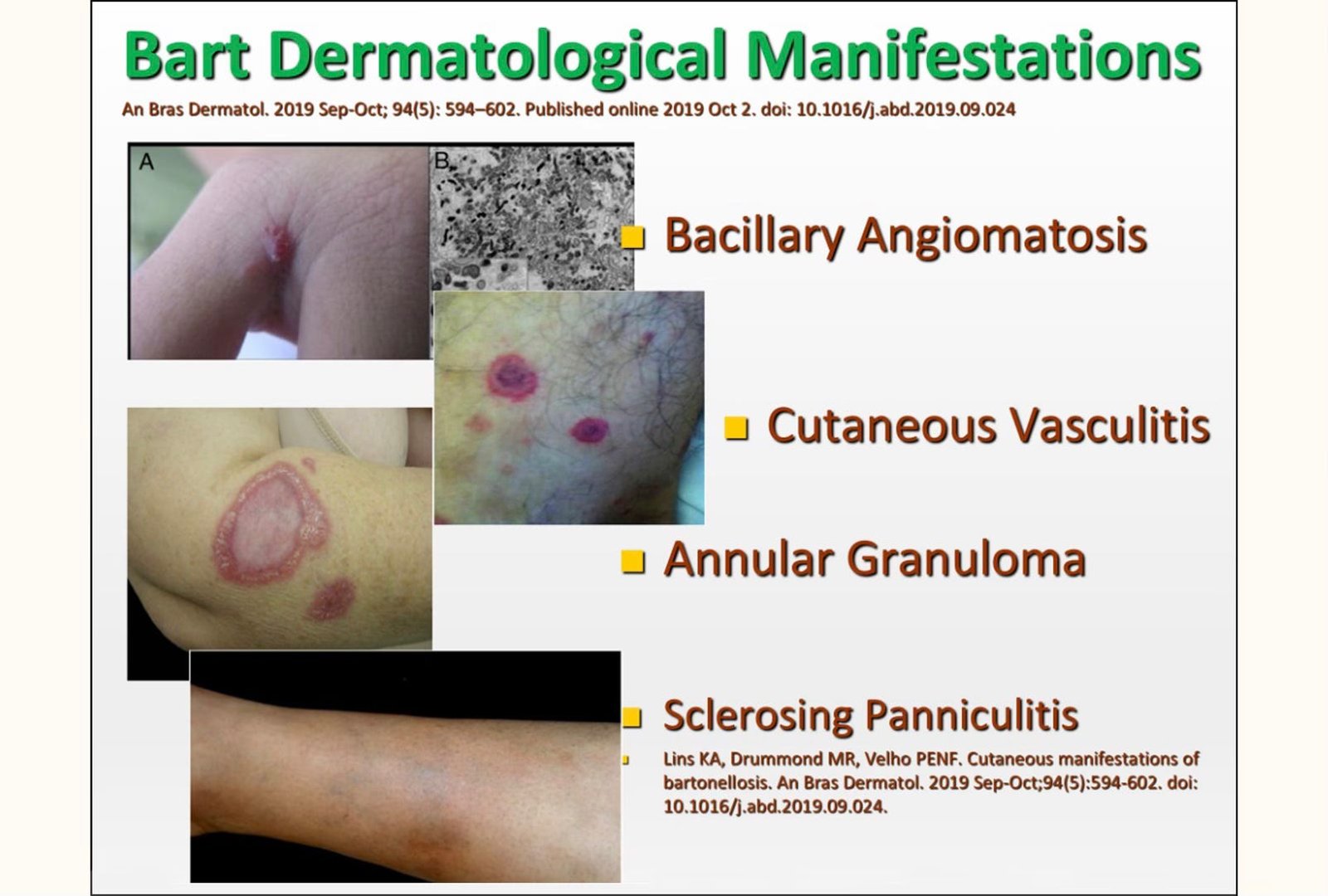 Bartonella dermatological manifestations slide with bacillary angiomatosis, cutaneous vasculitis, annular granuloma, and sclerosing panniculitis
