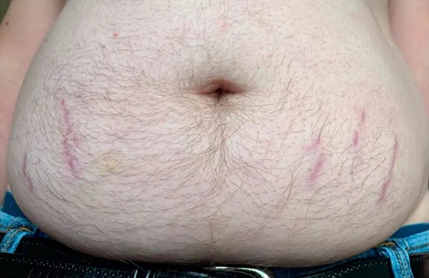 Bartonella striae or stretch-mark-like abdominal skin findings from Horowitz Substack