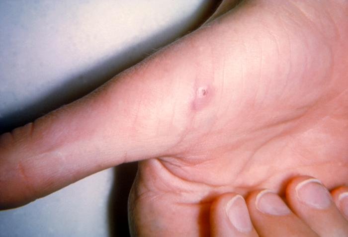 Cat scratch disease inoculation lesion on a finger