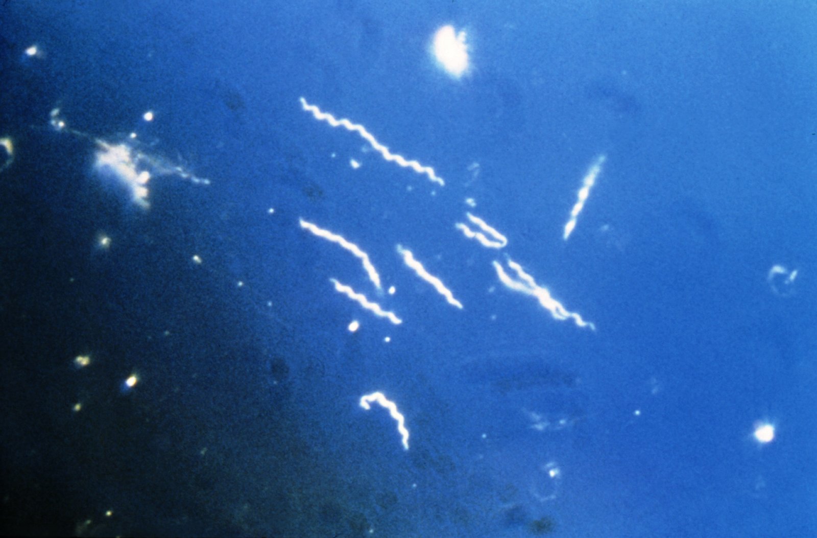 CDC microscopy image of Borrelia burgdorferi spirochetes