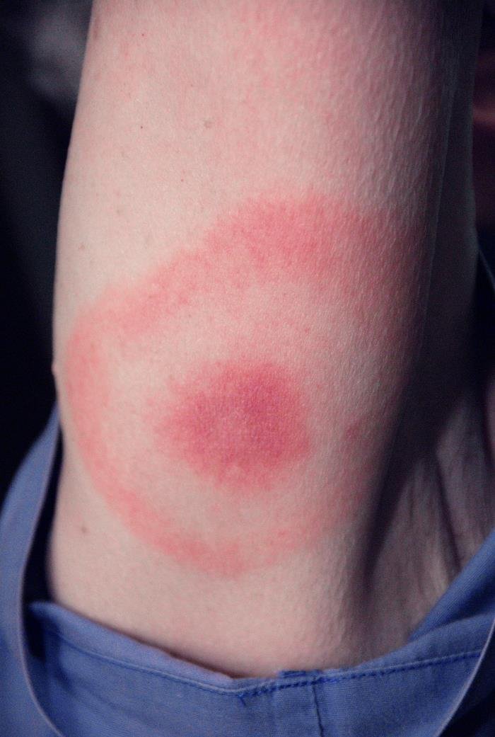 Erythema migrans - classic bullseye rash of Lyme disease